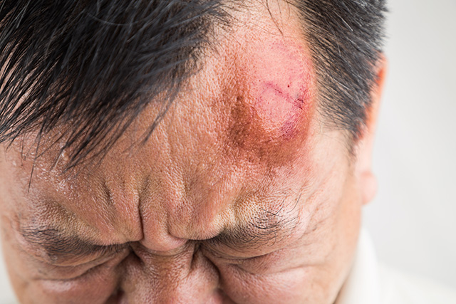 bump on head