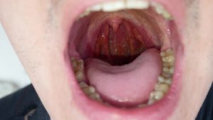 Is mouth cancer contagious